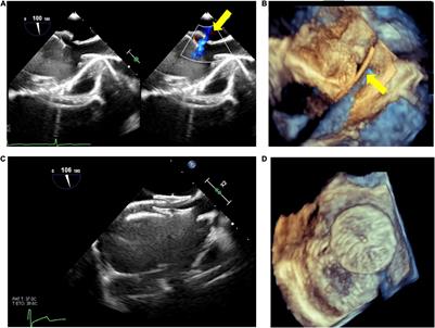 Renaissance of Cardiac Imaging to Assist Percutaneous Interventions in Congenital Heart Diseases:The Role of Three-Dimensional Echocardiography and Multimodality Imaging